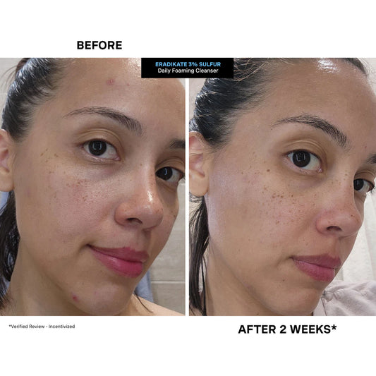 Kate Somerville - EradiKate™ 3% Sulfur Daily Foaming Cleanser + Acne Treatment | 120 mL