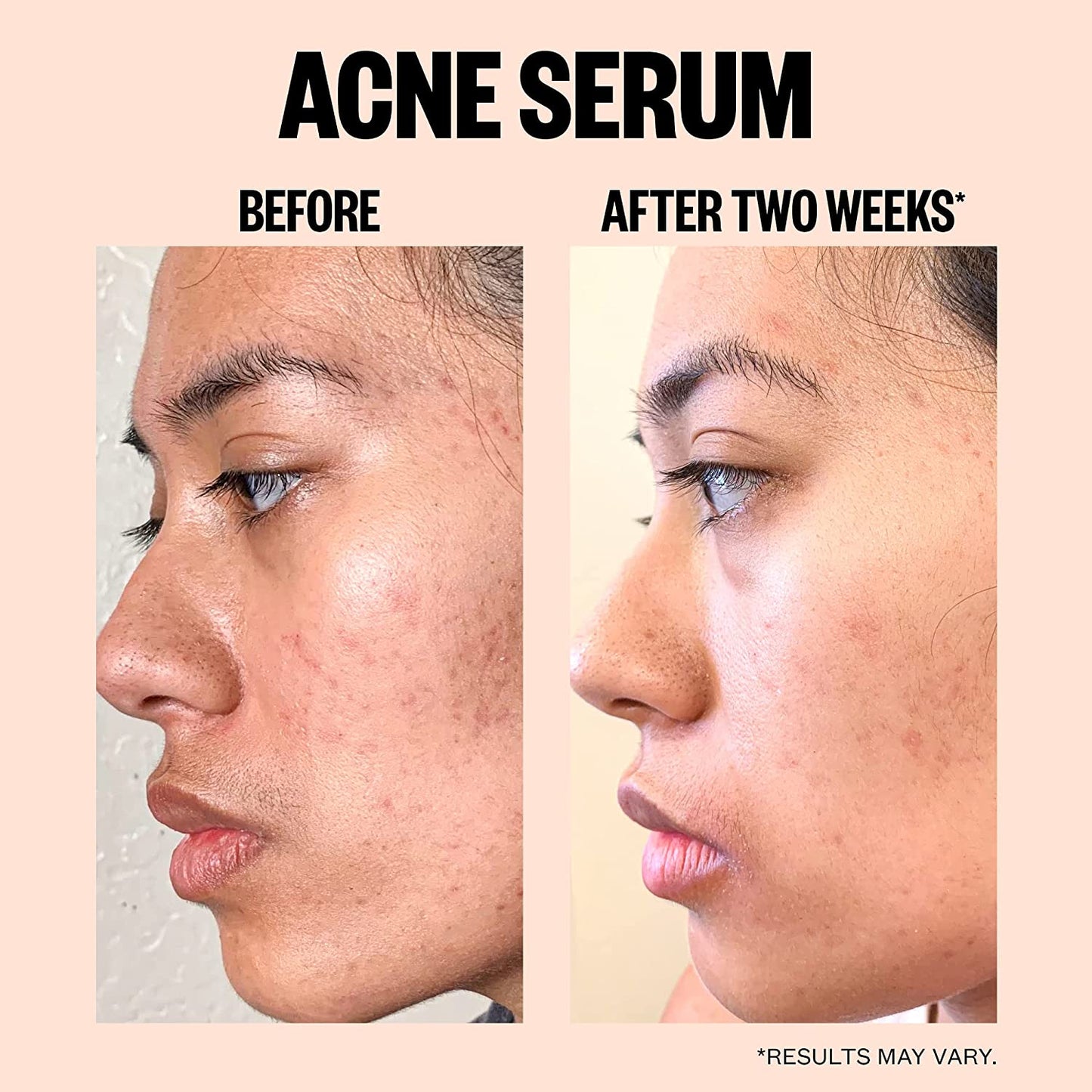 Peace Out - Salicylic Acid Acne Treatment Serum | 30 mL