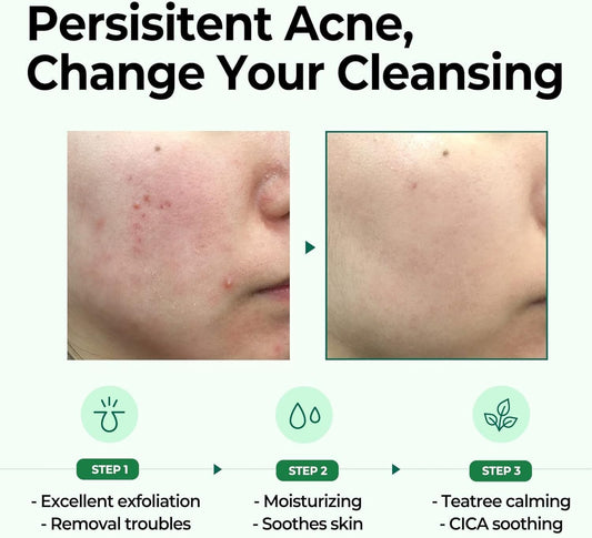 SOME BY MI - AHA BHA PHA 30 Days Miracle Cleansing Bar