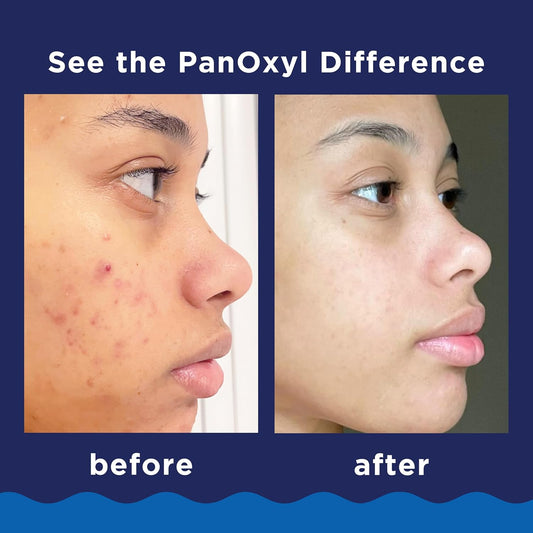 PanOxyl - ACNE FOAMING WASH 10% BENZOYL PEROXIDE | 156 g