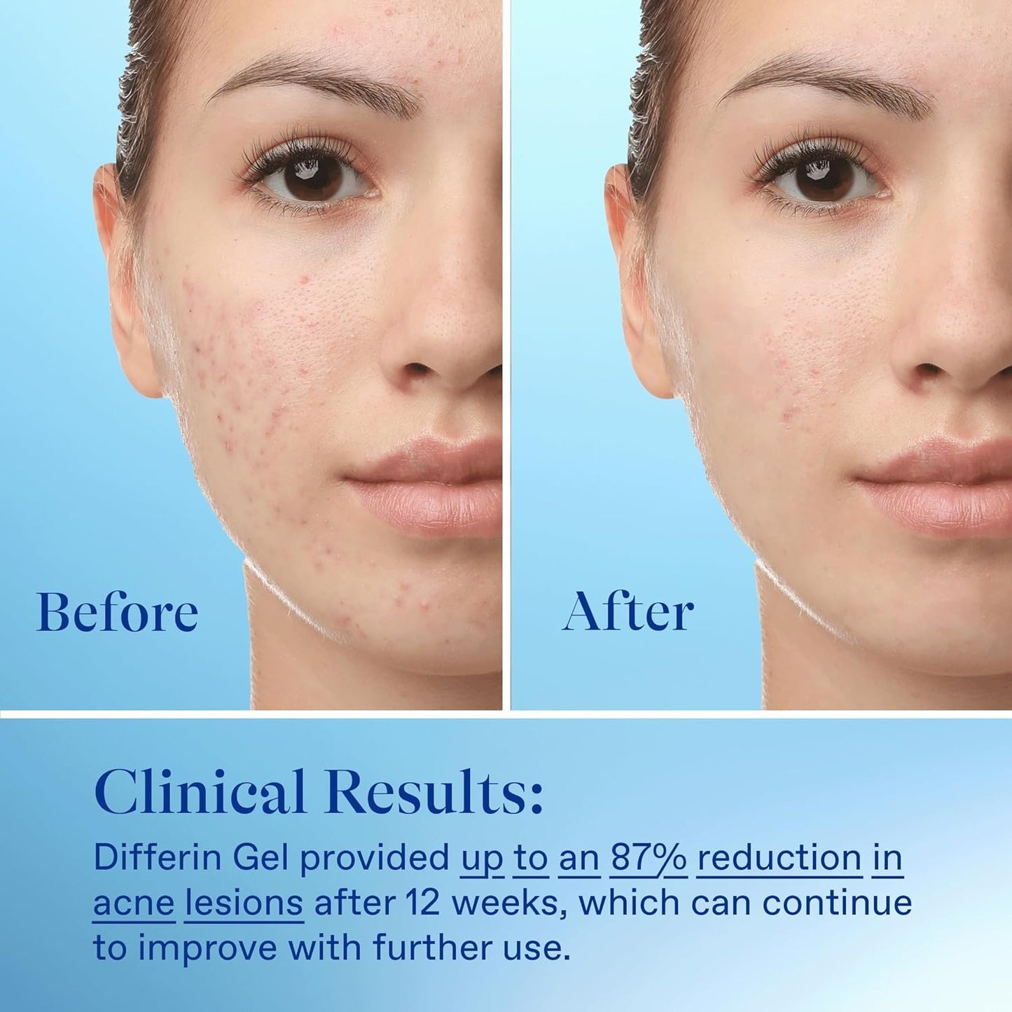Differin - Acne Treatment Gel, 30 Day Supply, Retinoid Treatment for Face with 0.1% Adapalene | 15 g