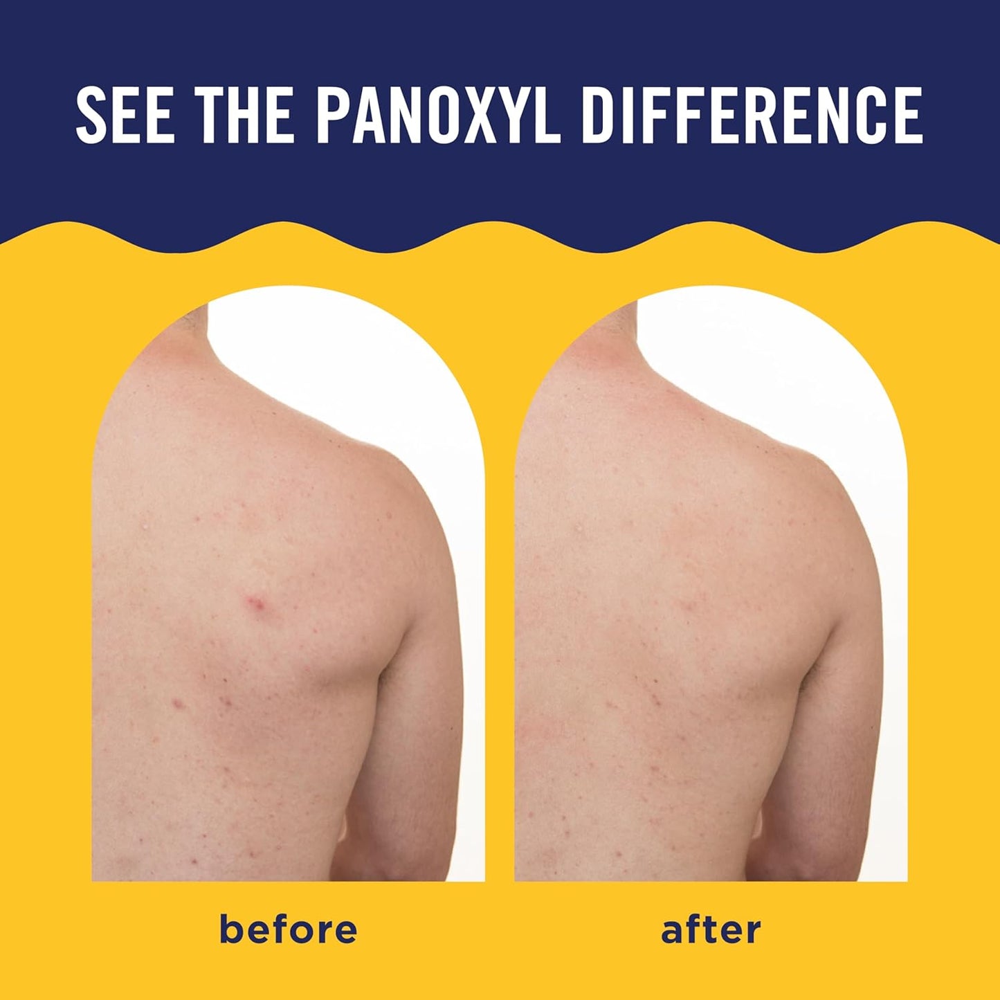PanOxyl - Acne Banishing Body Spray with 2% Salicylic Acid | 170 g