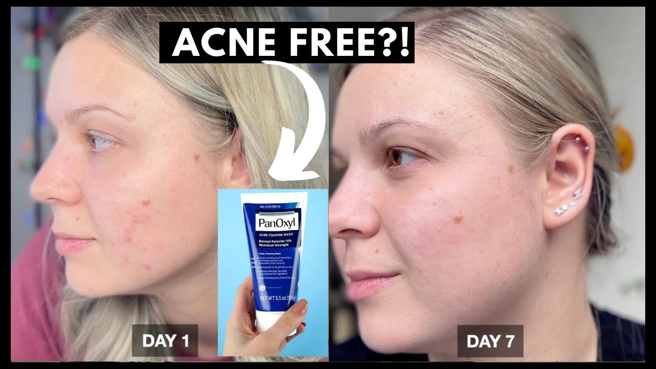 Acne Foaming Cream Wash, 10% Benzoyl Peroxide