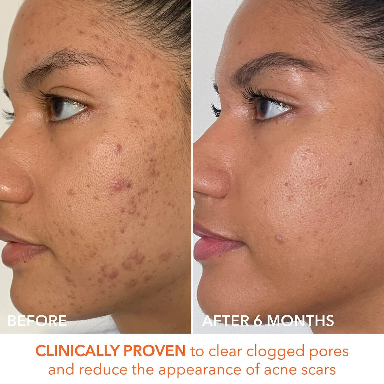 Dr. Dennis Gross Skincare - Alpha Beta® Extra Strength Daily Peel Pads | 5 Treatments