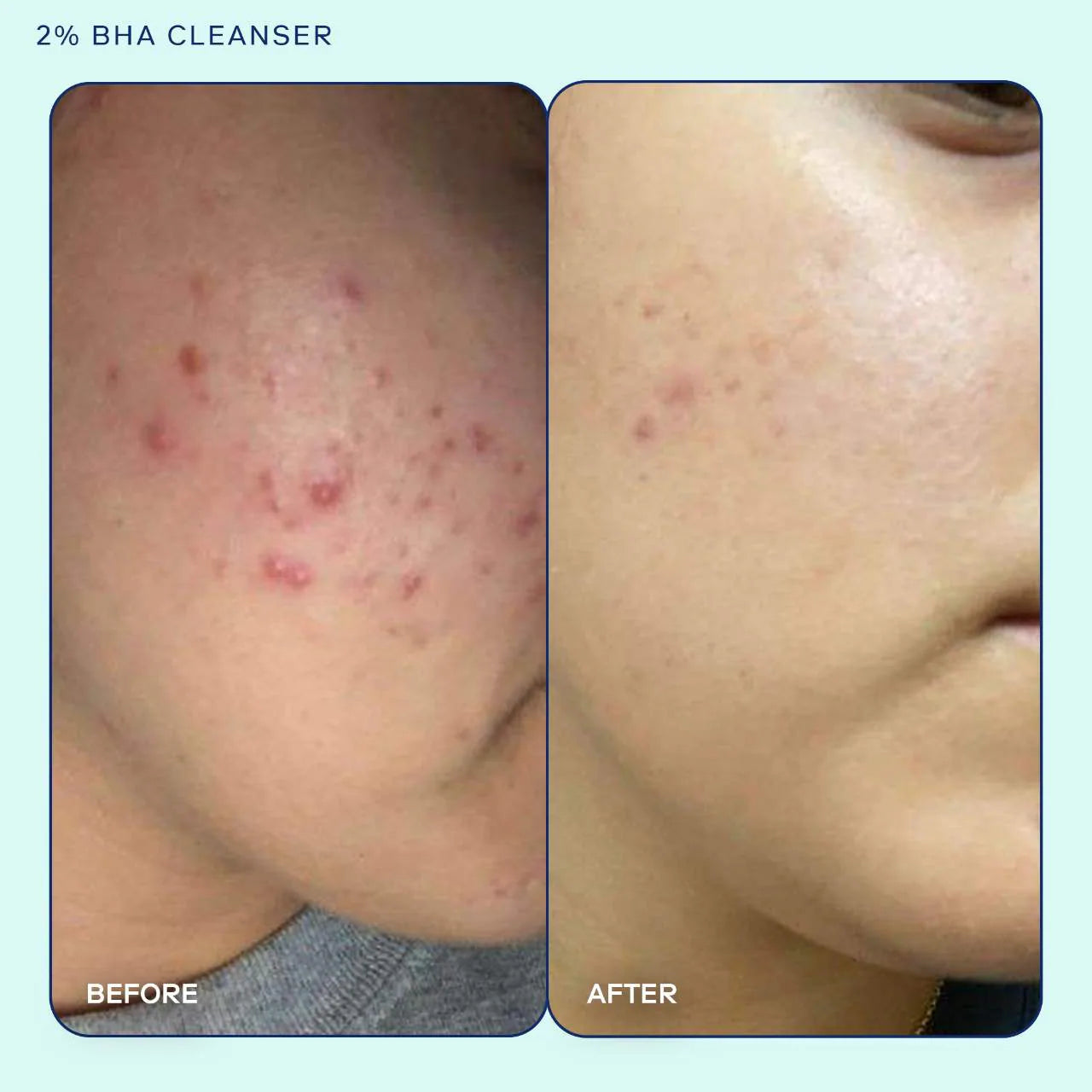 Skinfix - Acne+ 2% BHA + Azelaic Acid + Niacinamide + AHA Cleanser | 148 mL