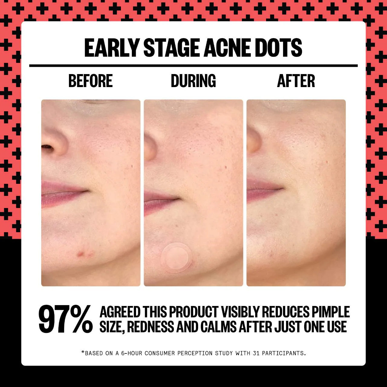 Peace Out - 2% Salicylic Acid Early Stage Acne Dot