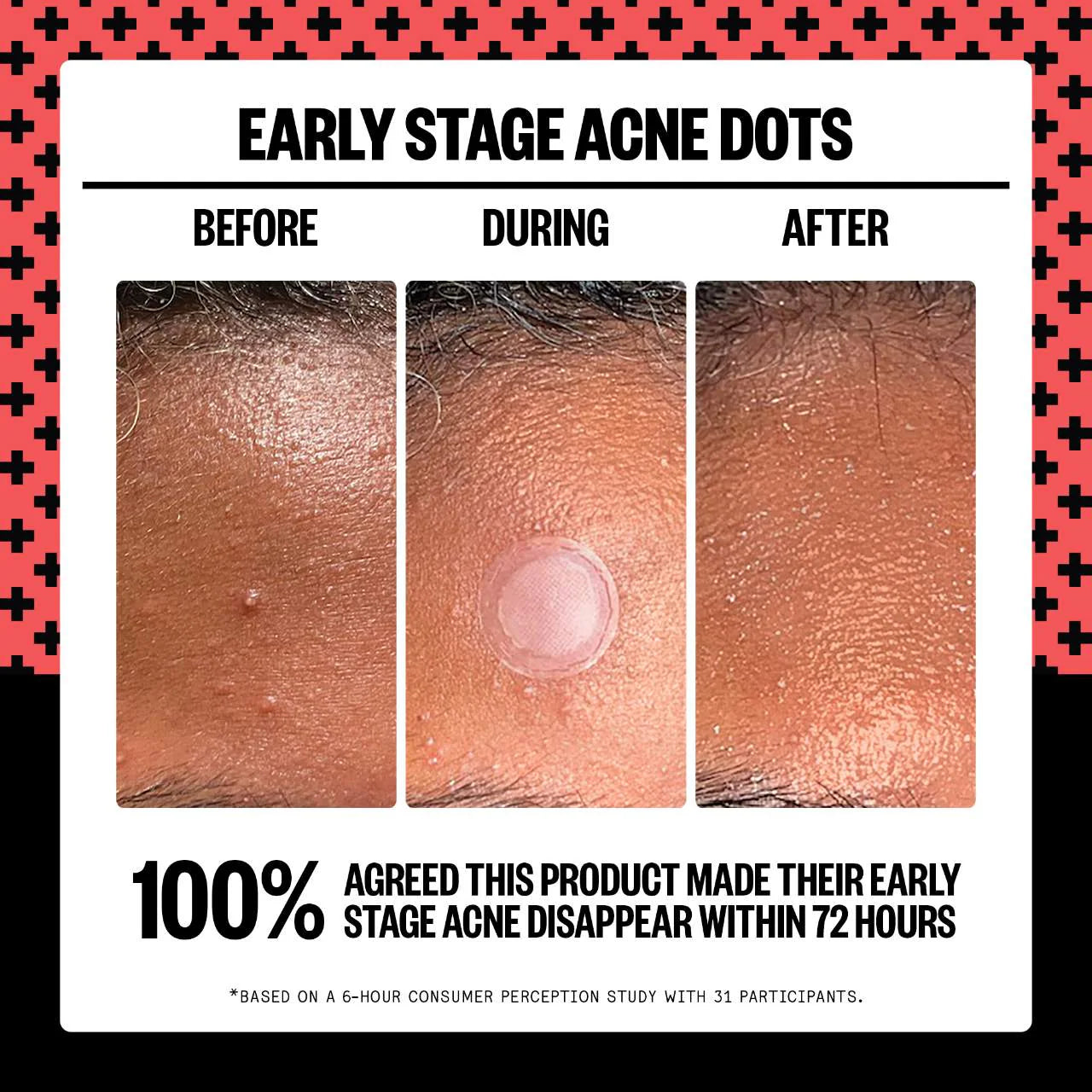 Peace Out - 2% Salicylic Acid Early Stage Acne Dot