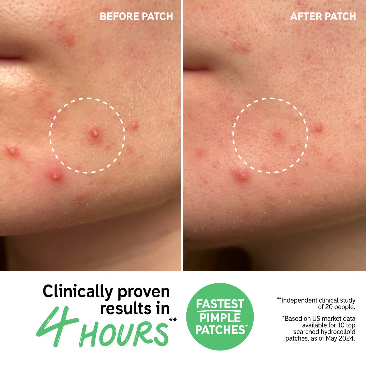 The INKEY List - Hydrocolloid Invisible Pimple Patches + Salicylic Acid | 22 Patches