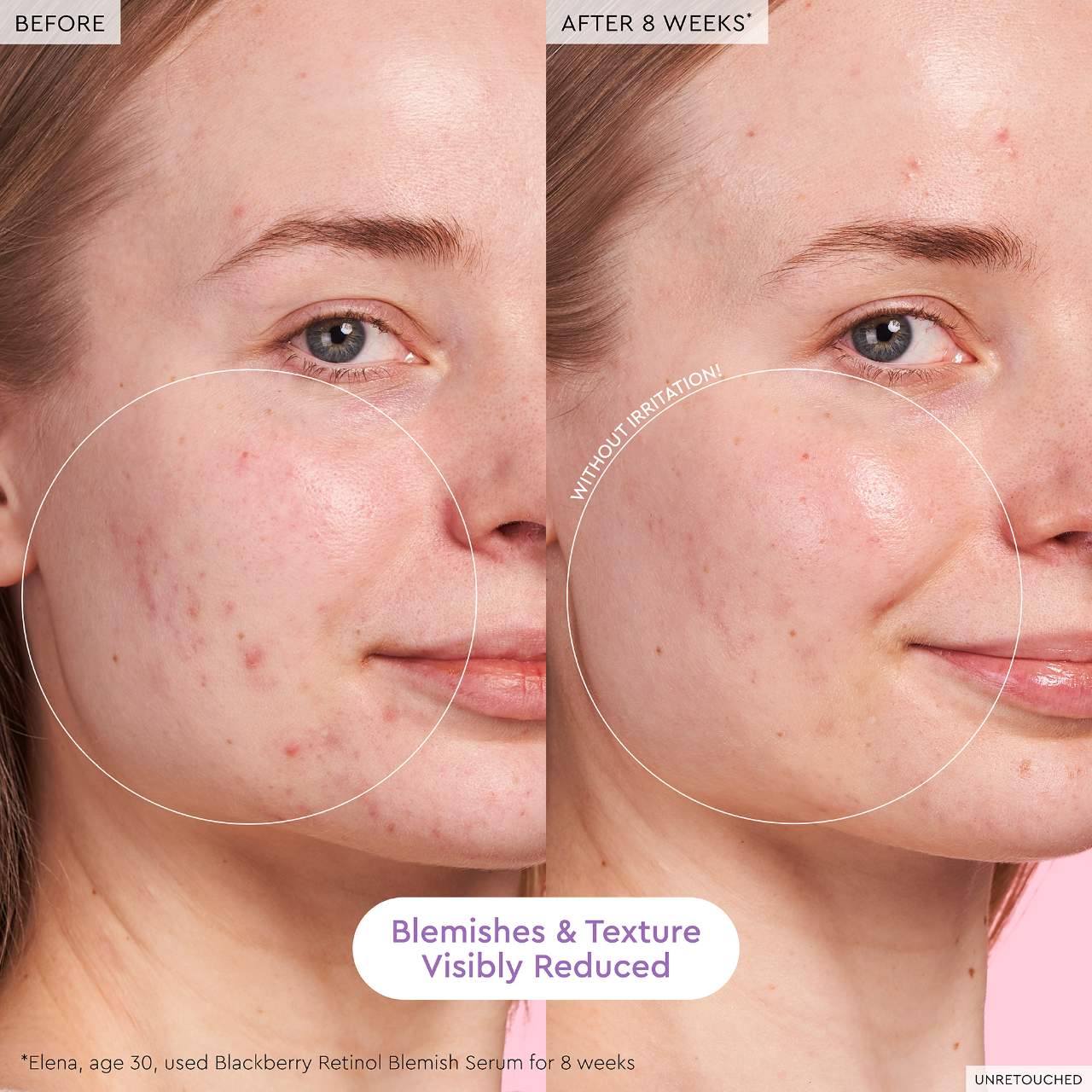 Glow Recipe - Blackberry Retinol Blemish Serum | 30 mL