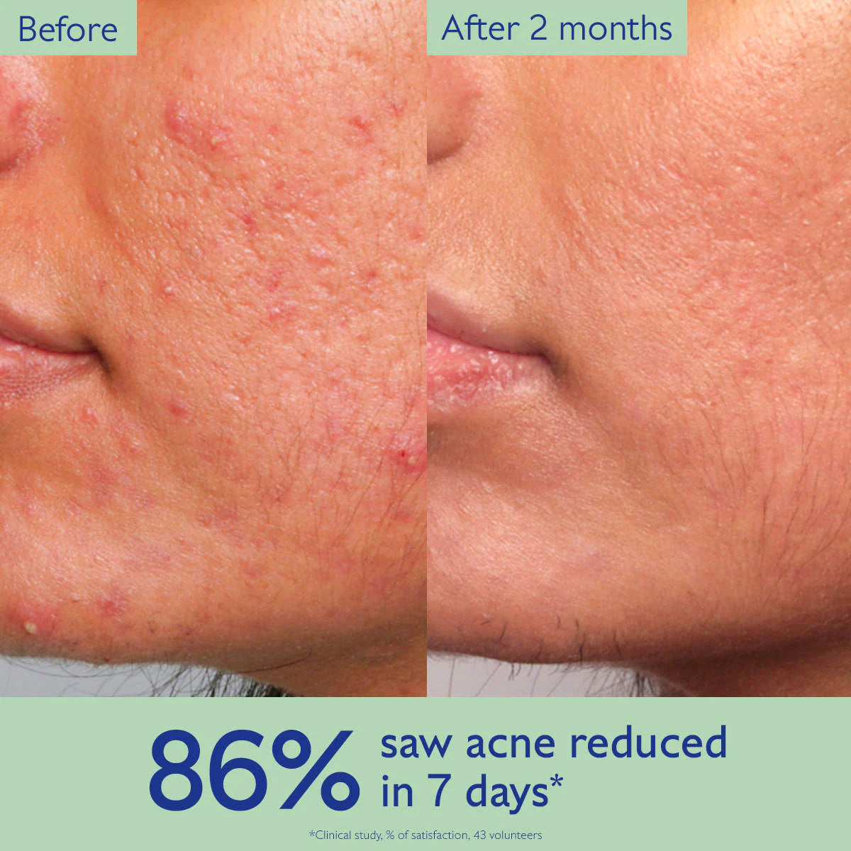 Caudalie - Vinopure Acne-Prone Skin Essentials