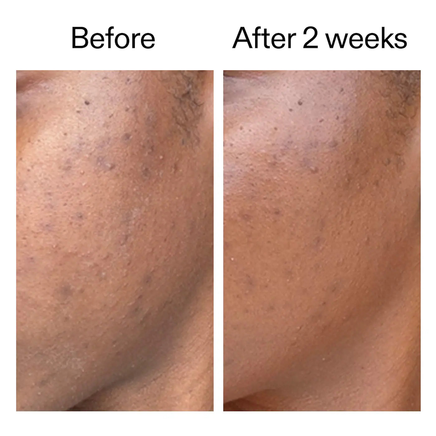 The INKEY List - 360 Acne Clearing Serum with Dioic & Salicylic Acid | 30 mL