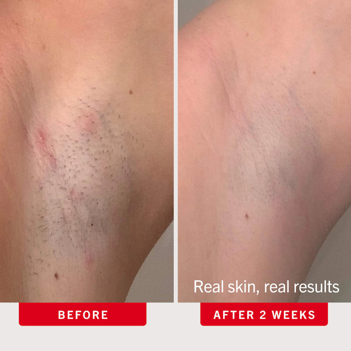 First Aid Beauty - Ingrown Hair Pads with BHA & AHA 28 PADS