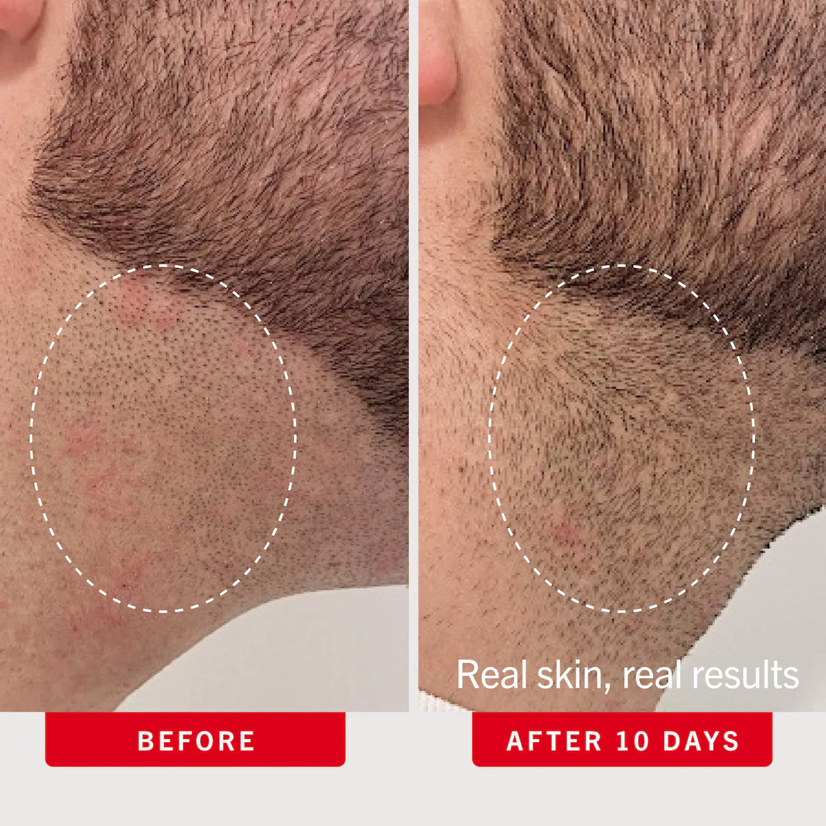 First Aid Beauty - Ingrown Hair Pads with BHA & AHA 28 PADS