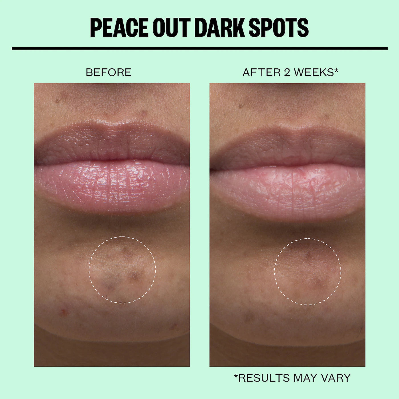 Peace Out - Microneedling Dark Spot Brightening Dots | 12 patches